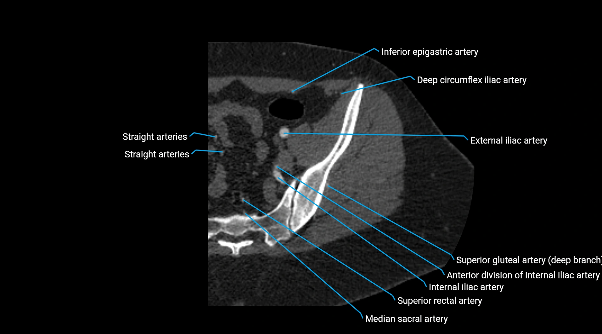 CTA lower limb cross sectional anatomy labelled image _30.webp